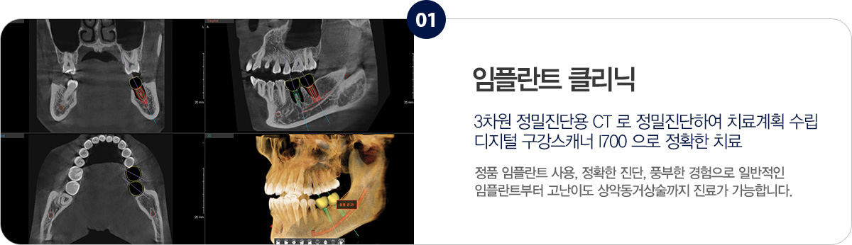 임플란트 클리닉